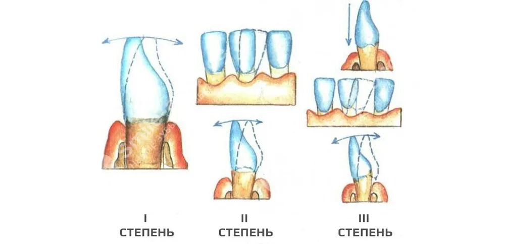 Стадии подвижности зубов при пародонтите