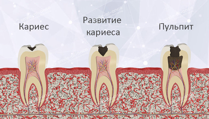 Пульпит