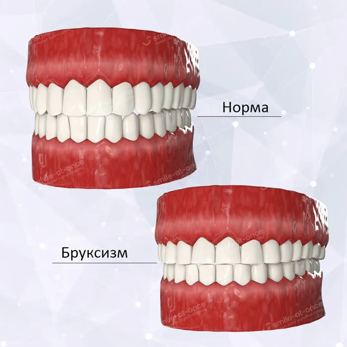Стираемость зубов и её симптомы