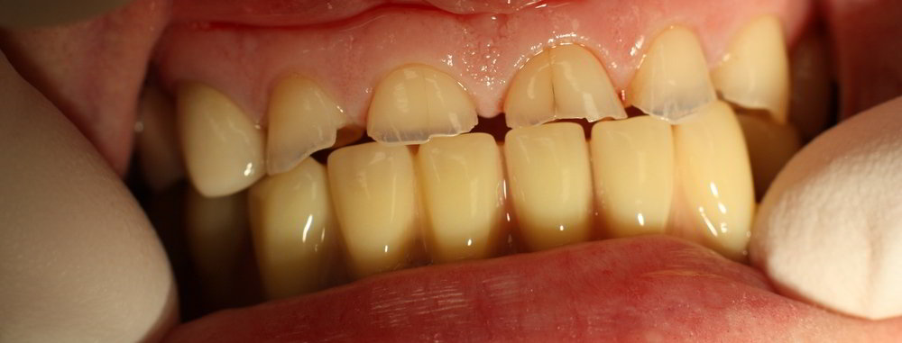 Изменение зубочелюстной системы при повышенной стираемости твердых тканей зубов.