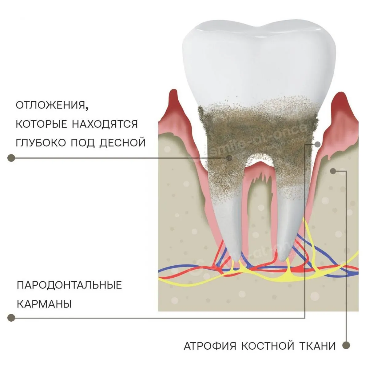 Карман в десне между зубами: 10 признаков того, что необходимо начинать лечение