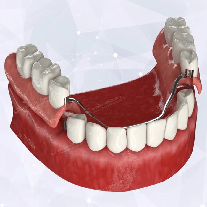 Установка съемного протеза на жевательные зубы