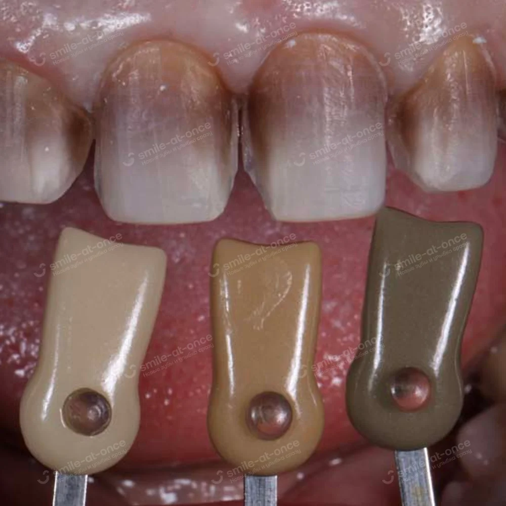 подготовка тетрациклиновых зубов к лечению