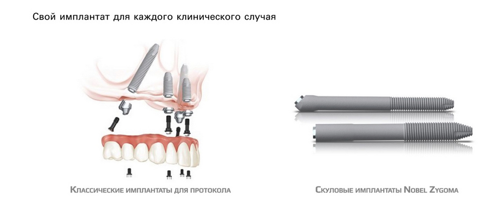 Разные импланты для разных клинических случаев Разные импланты для разных клинических случаев