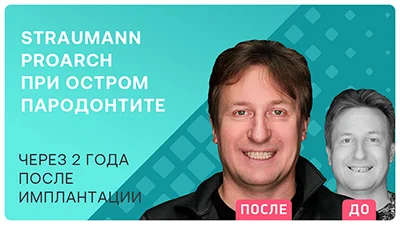 Видео-отзыв через 2 года после имплантации Straumann ProArch при остром пародонтите