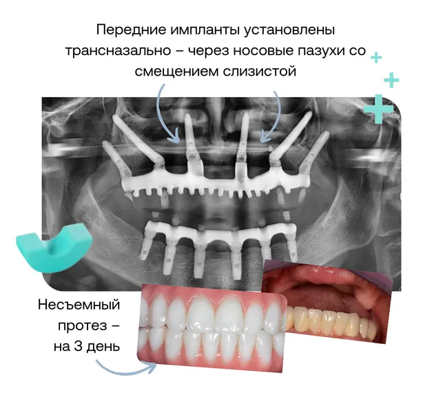 Трансназальная имплантация зубов