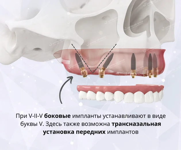 Имплантация зубов методом V-II-V