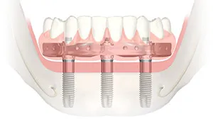 имплантация зубов трефоил