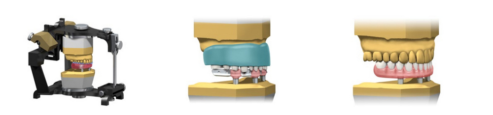 Изготовление зубных протезов на импланты