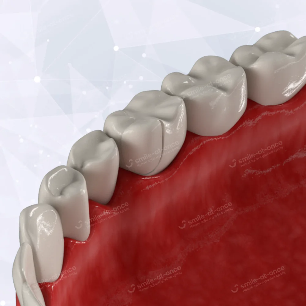 Трещины и сколы зубов