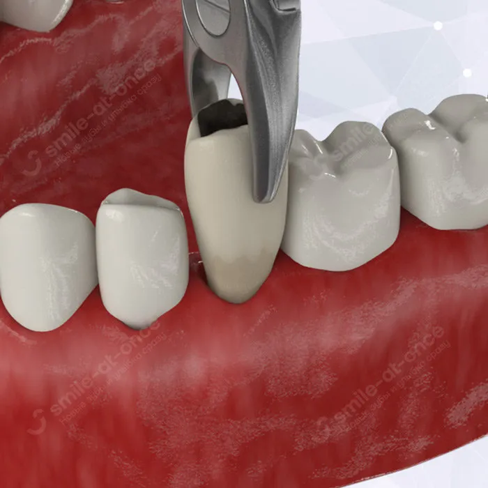 Способы удаления зуба