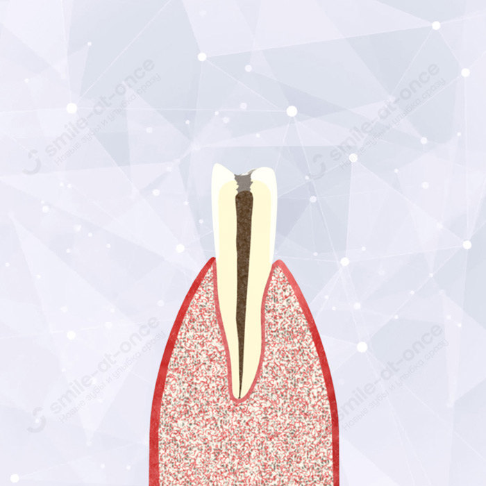 Этапы удаления зуба