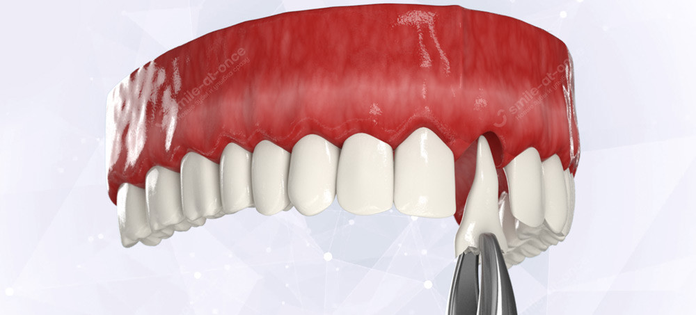 Схема удаления зуба