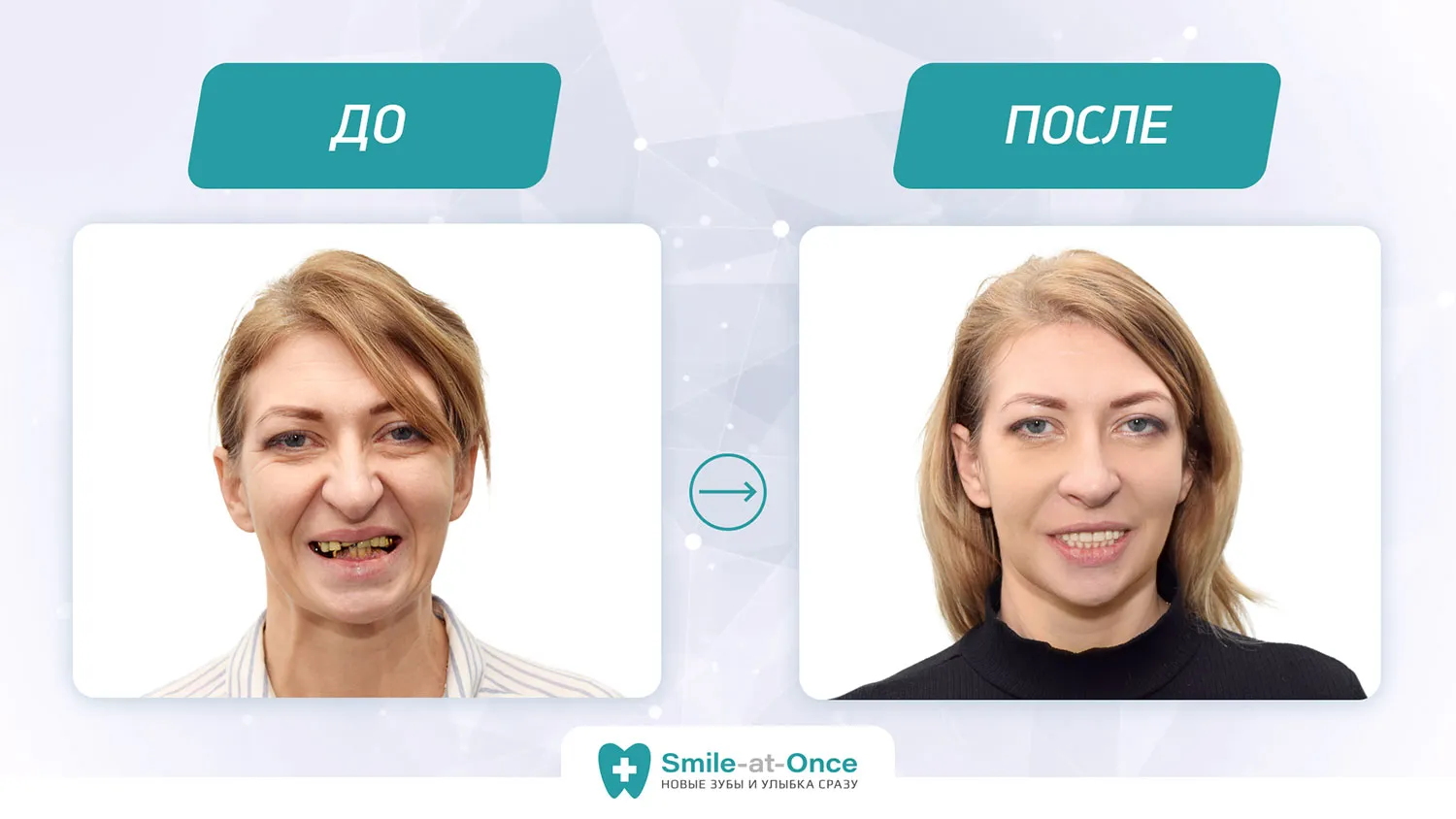 До и после имплантации зубов all-on-4