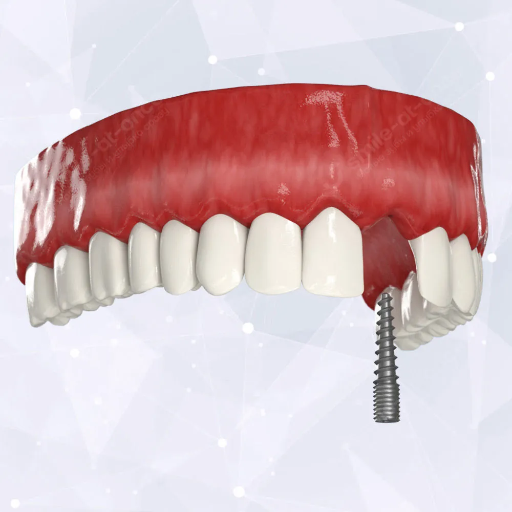 Как восстановить удаленный зуб