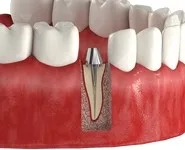 Установка вкладки на зубы