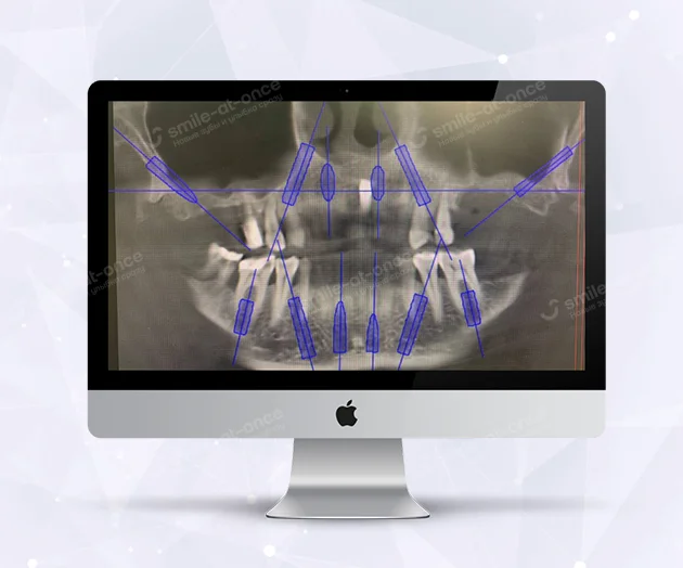 3D-планирование имплантиции зубов