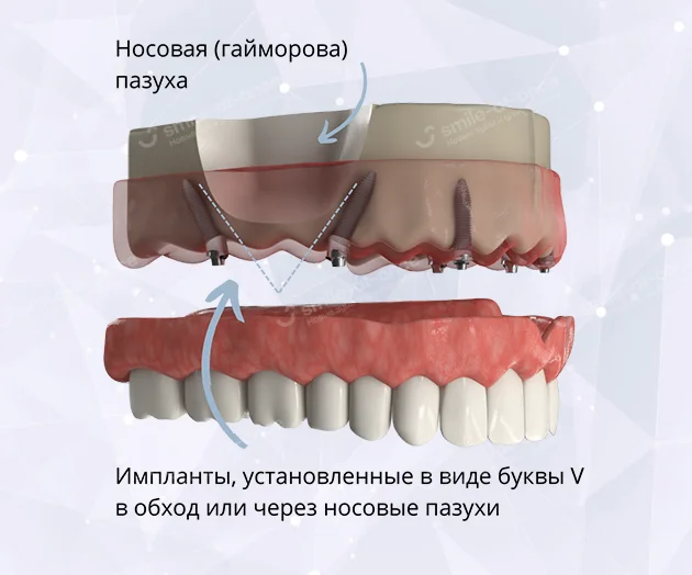 Имплантация зубов V-II-V