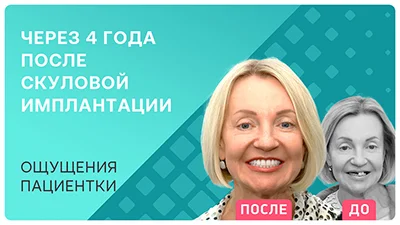 Видео - Имплантация Nobel Zygoma: ощущения через 4 года