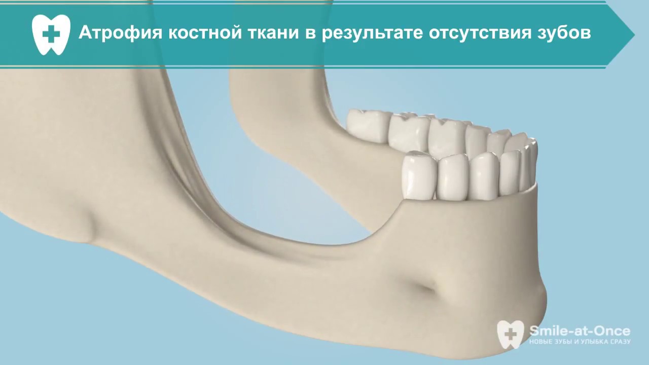 видео о наращивании костной ткани