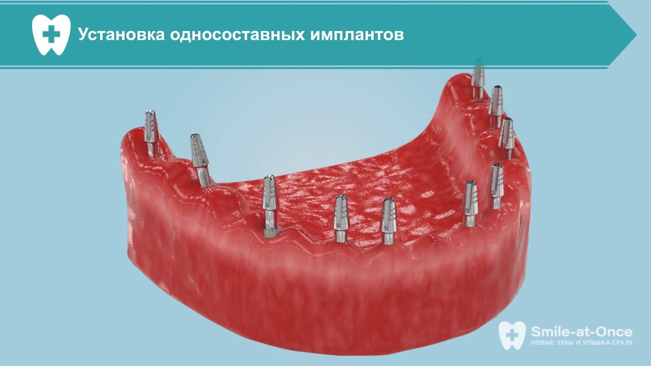 Видео о базальной имплантации всех зубов