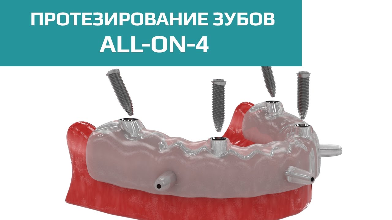 Видео о протезировании зубов All-on-4
