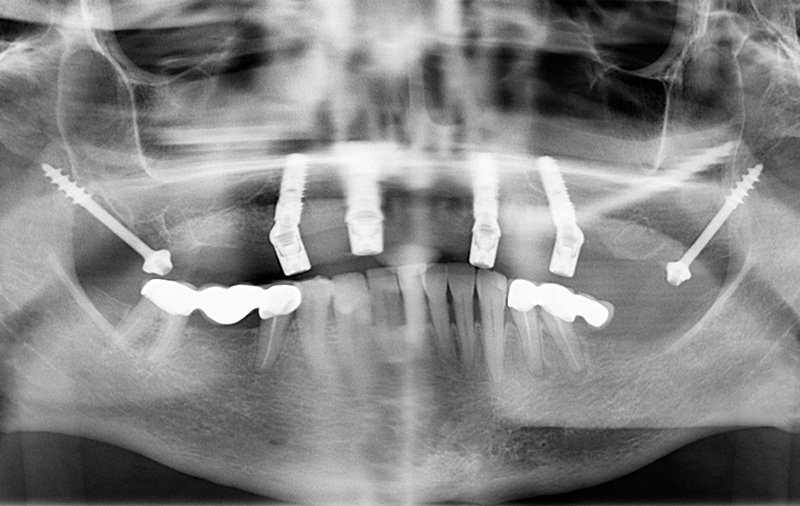 Снимок восстановление зубов верхней челюсти при помощи протокола имплантации All-on-6