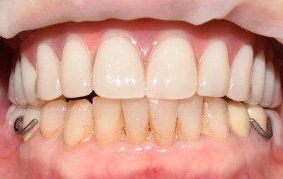 восстановление зубов верхней челюсти при помощи протокола имплантации All-on-6