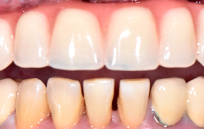 фото восстановленных зубов после имплантации