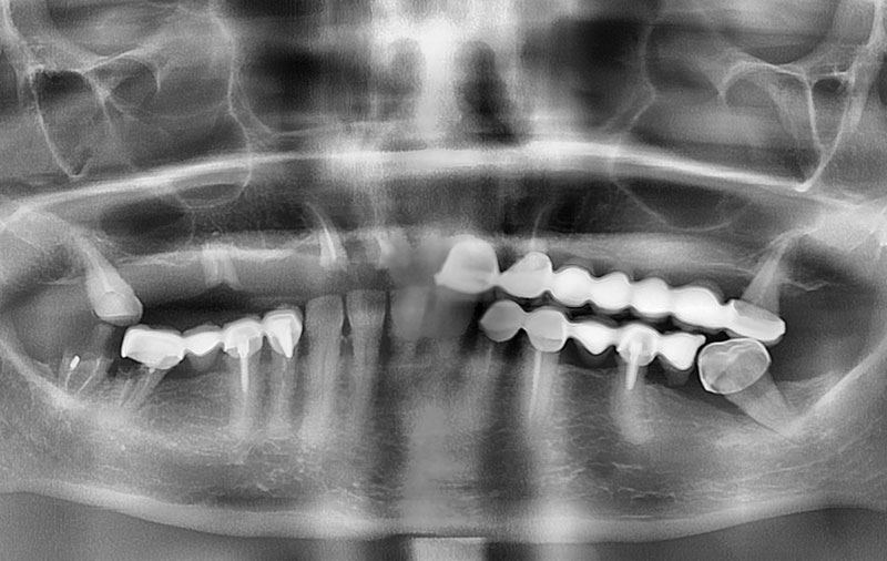 Снимок фото разрушенных зубов