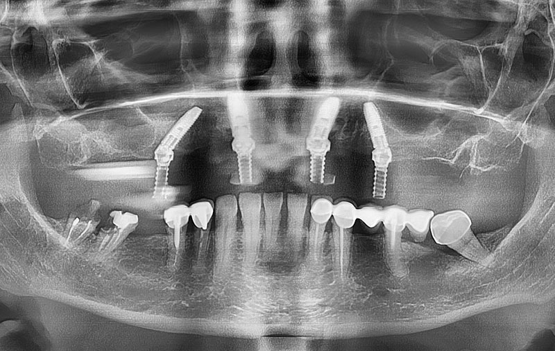 Снимок фото восстановленных зубов после имплантации