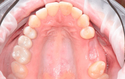 Фото до имплантации жевательных зубов верхняя челюсть