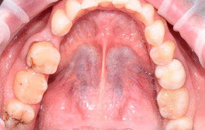 Фото до имплантации жевательных зубов нижняя челюсть