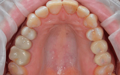Фото после имплантации жевательных зубов верхняя челюсть