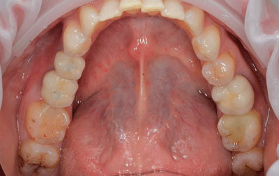 Фото после имплантации жевательных зубов нижняя челюсть
