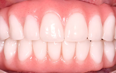 Фото зубов в процессе лечения