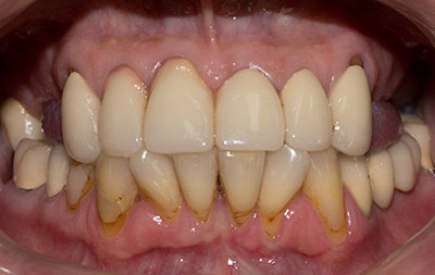 Отсутствие зубов на верхней челюсти и недостаток костной ткани