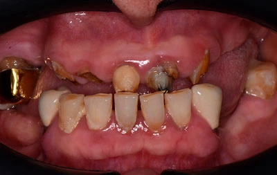 Фото разрушенных зубов до имплантации