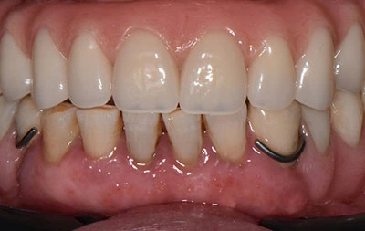 Фото зубов после имплантации зубов и установки протеза