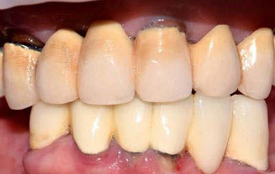 Частичное отсутствие зубов и коронки