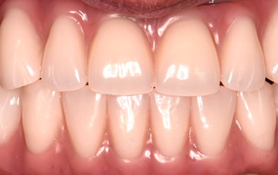 Фото восстановленных зубов