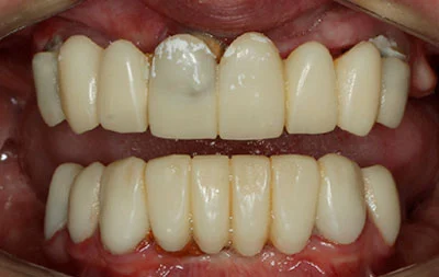 Фото проблем с зубами пациента до имплантации