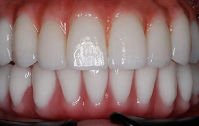 Фото после замены адаптационного зубного протеза на постоянный