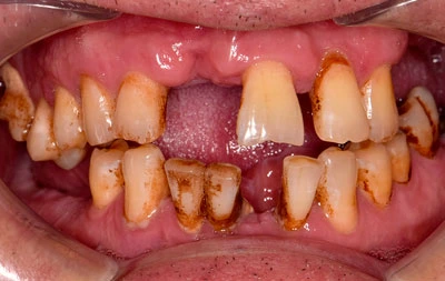 Фото состояния зубов до проведения имплантациии