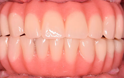 Фото после установки зубных имплантов и протезов
