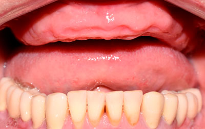 фото отсутствующих зубов