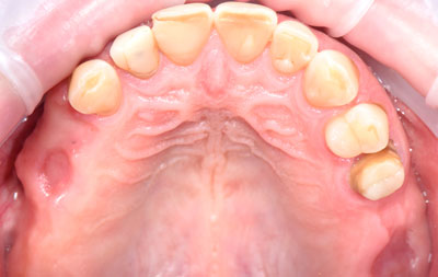 Фото отсутствия жевательных зубов на верхней челюсти