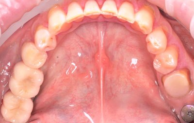 Фото после имплантации нижних зубов