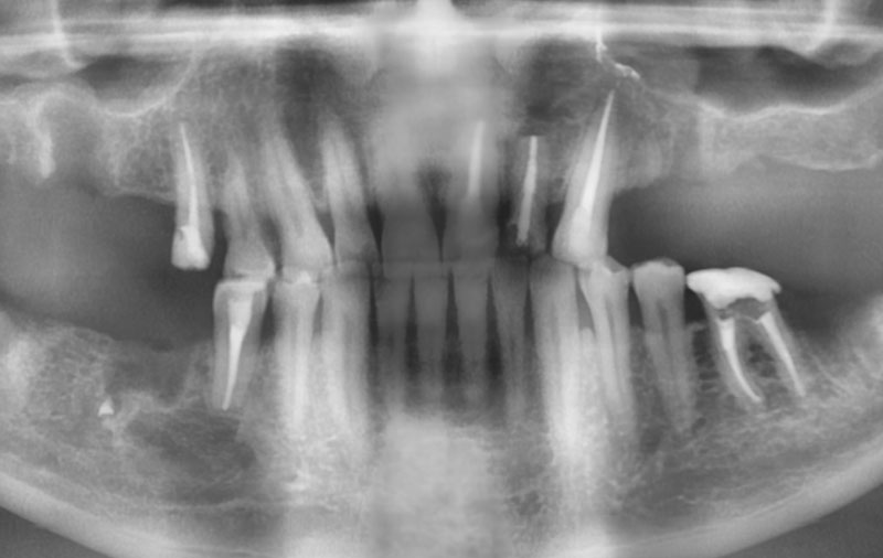 Снимок Фото отсутствия жевательных зубов на верхней челюсти