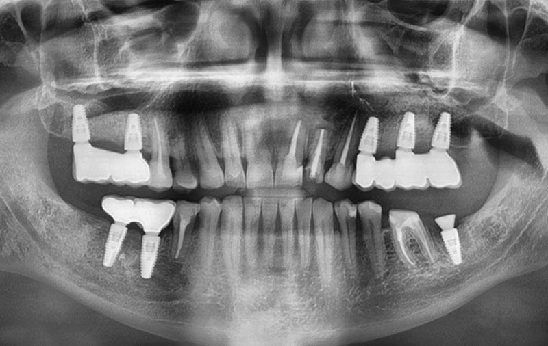 Снимок Фото после имплантации верхних зубов